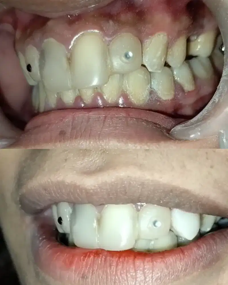 Gingsul gigi kelinci dll