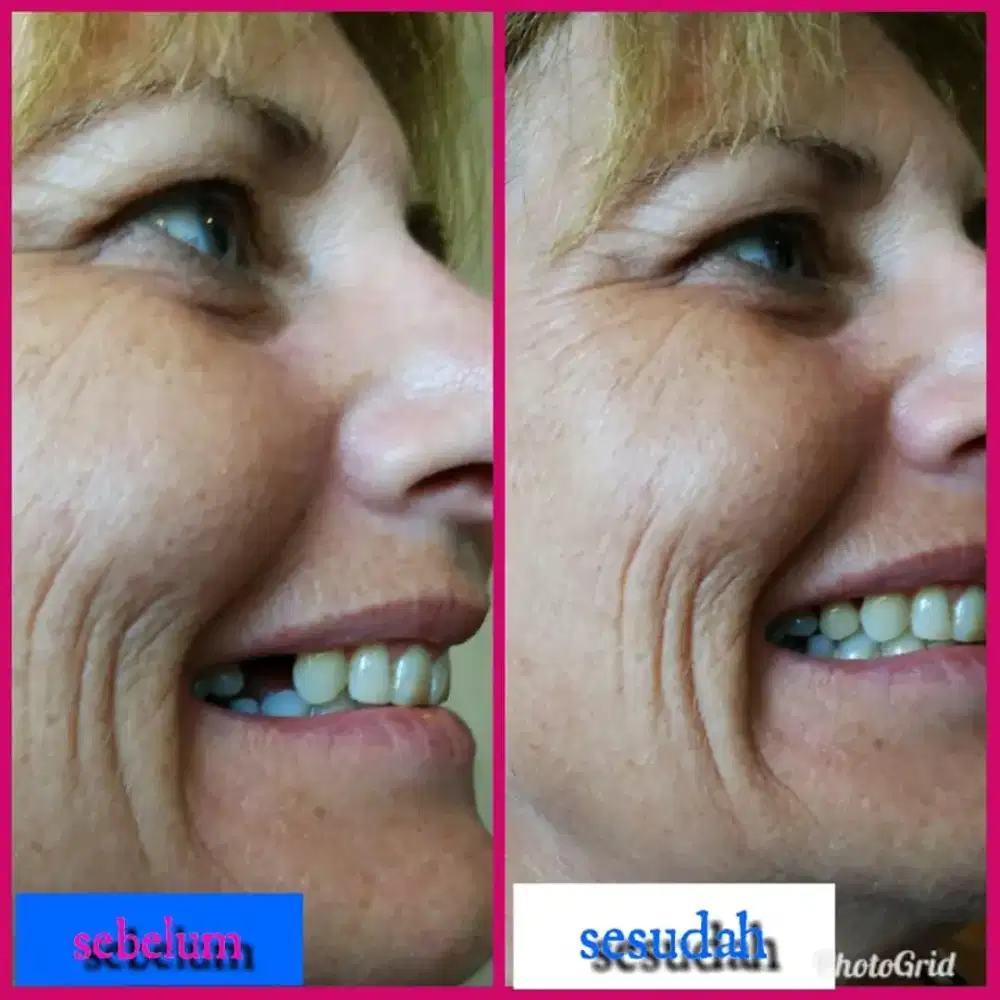 Pasang gigi palsu bagus terlaris