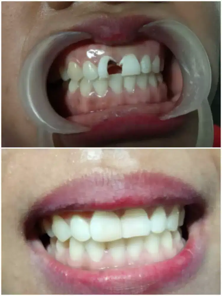 GIGI OMPONG DAN GIGI KROPOS.