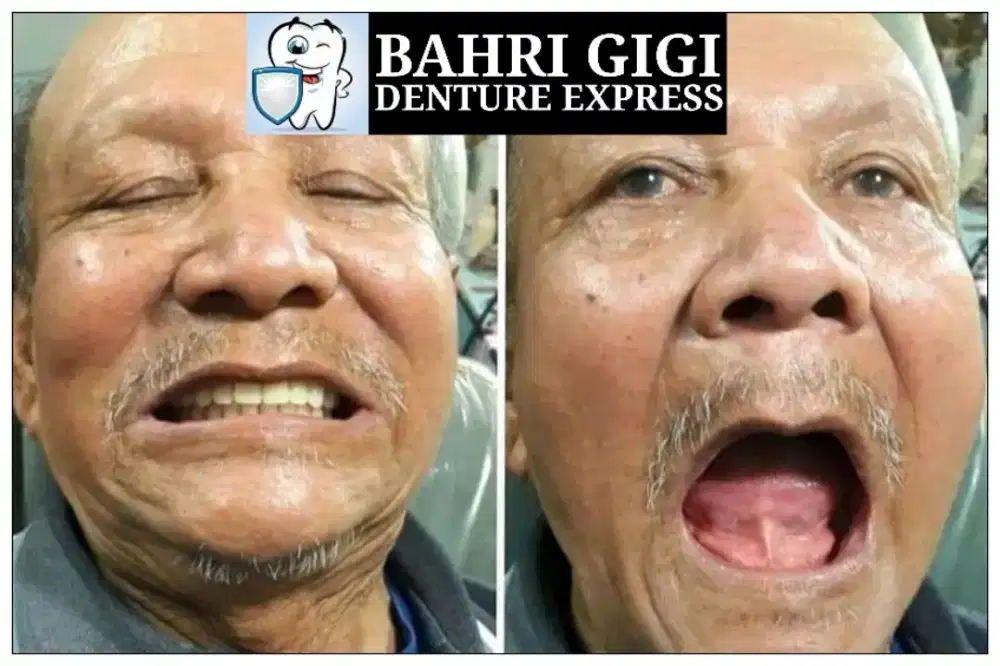 Pasang gigi palsu murah