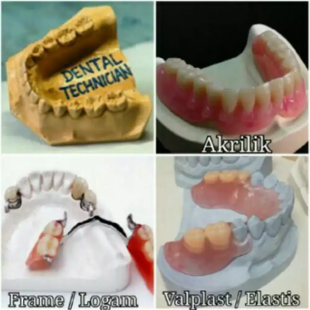 PERBAIKAN GIGI KROPOS DAN GIGI OMPONG