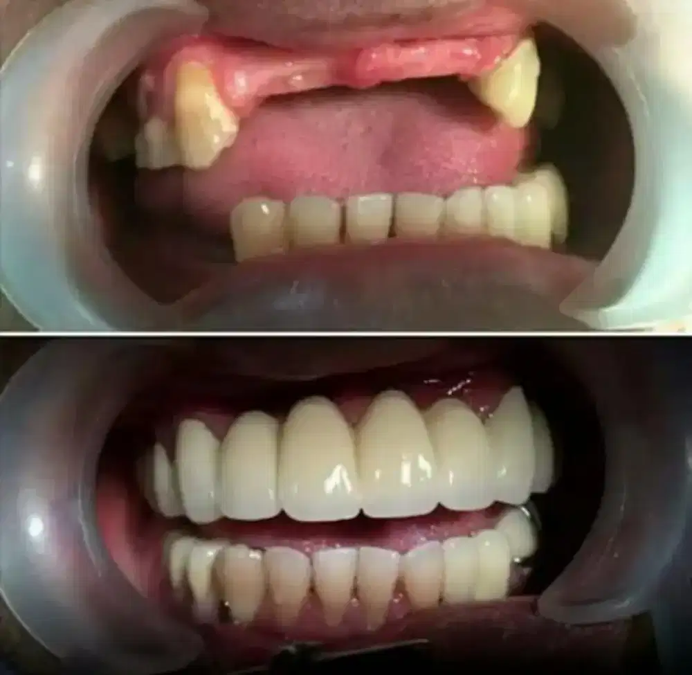 VALPLAST DAN AKRILIK NYAMAN DIPAKAI