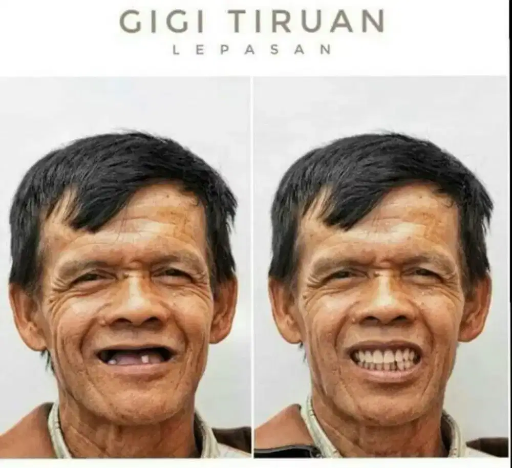 Pasang gigi palsu rapi bagus