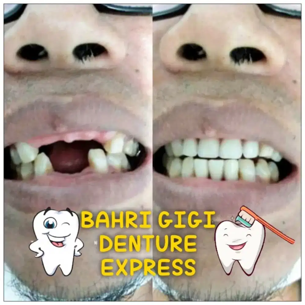 Pasang gigi palsu berkualitas bagus