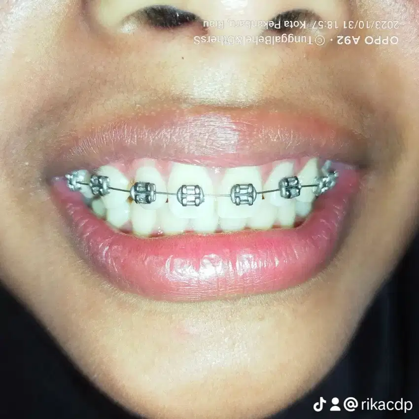Behel fashion atas tw bawah aja ( 1 rahang )