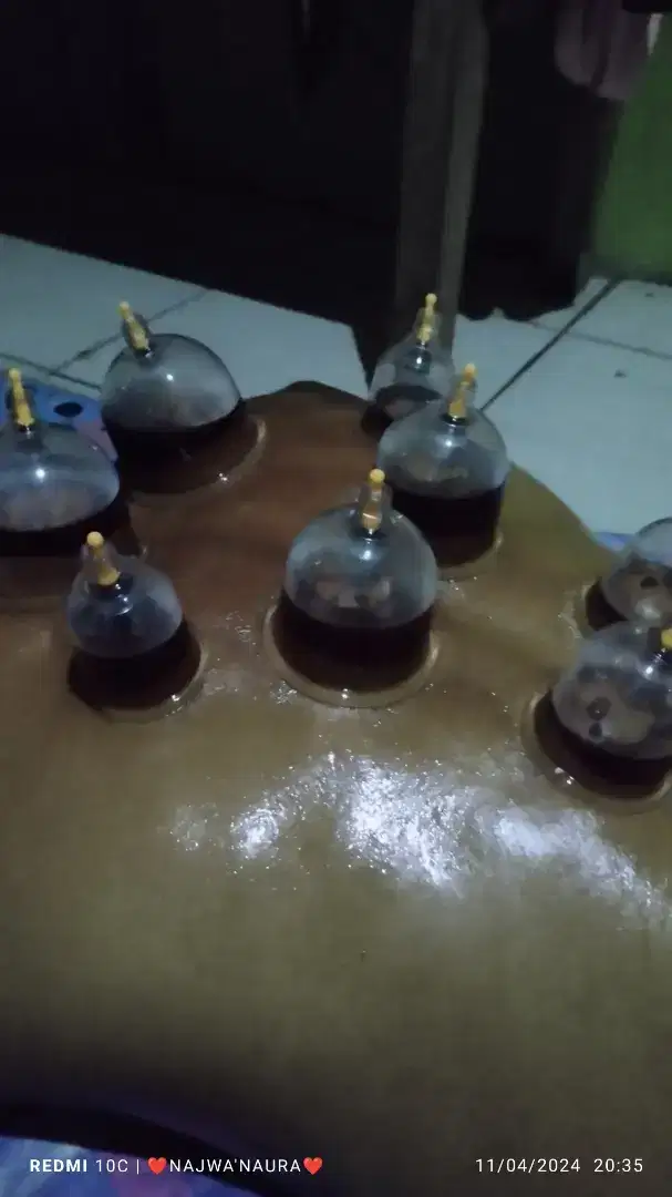 Terapi Pengobatan Bekam
