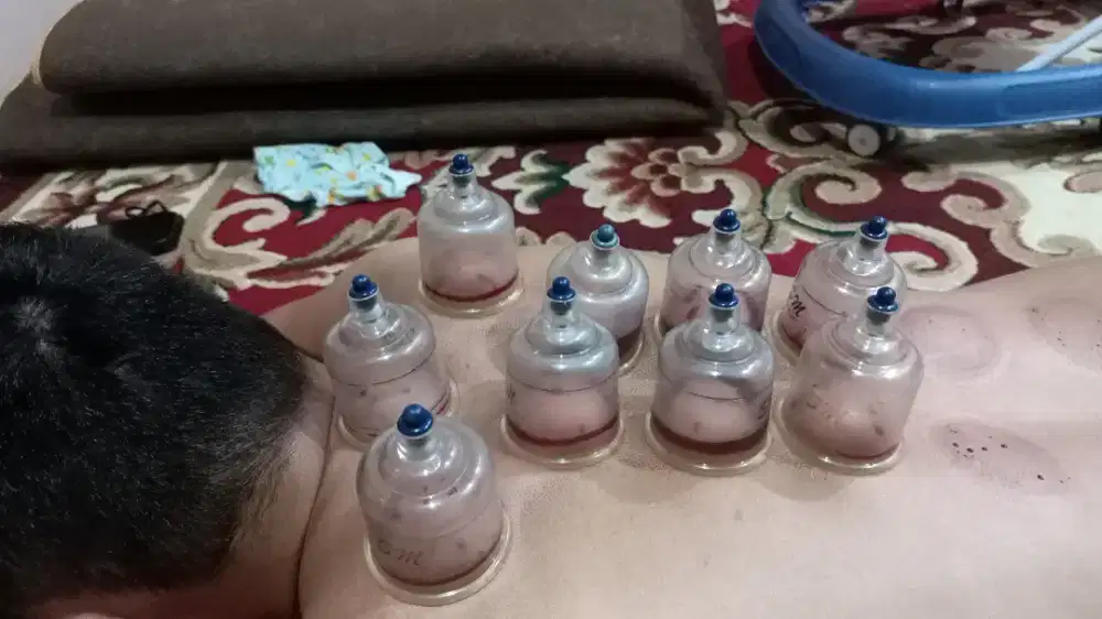 Terapis bekam repleksi n lintah