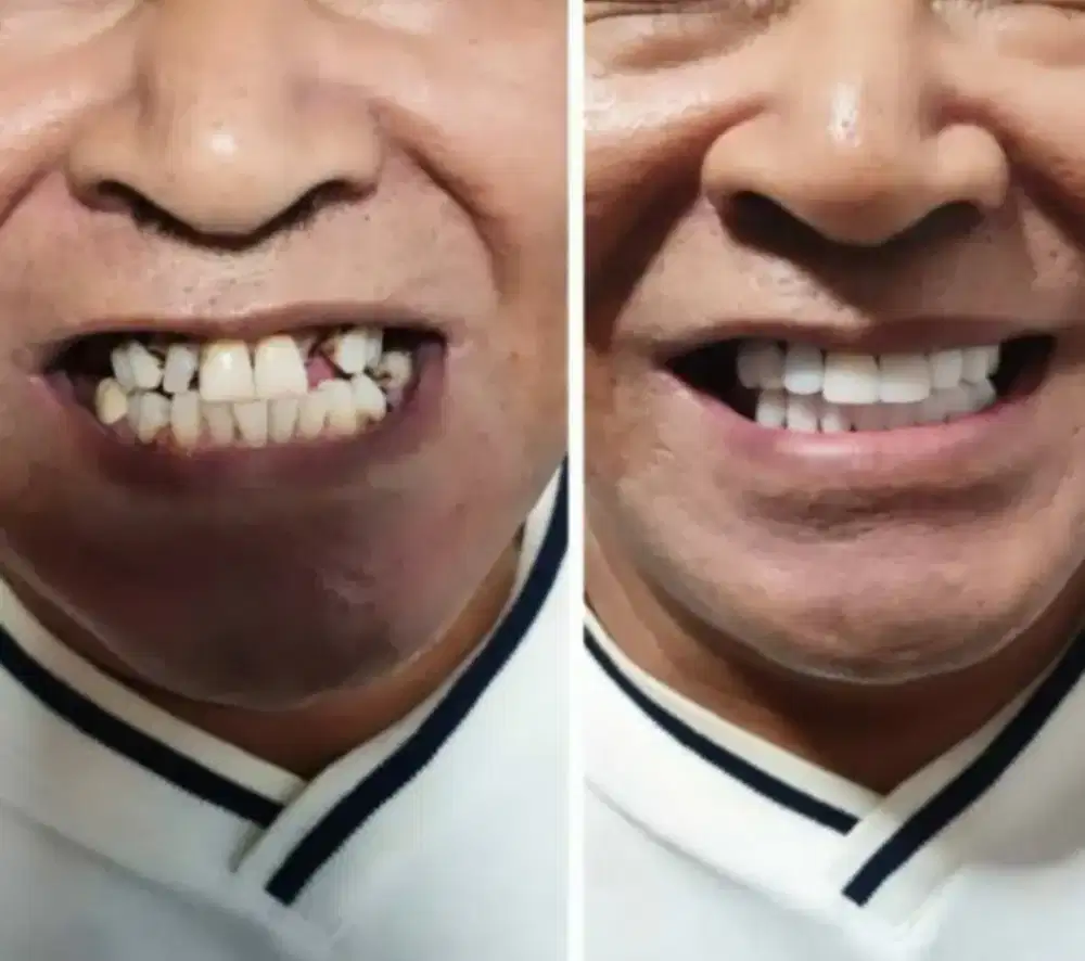 Veneer vinir gigi  memutihkan dan merapihkan gigi