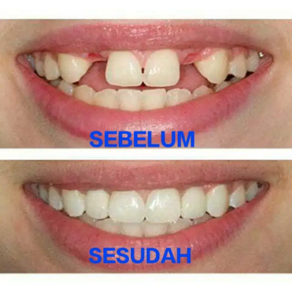 AHLI PASANG GIGI PALSU EDY Ef gading serpong