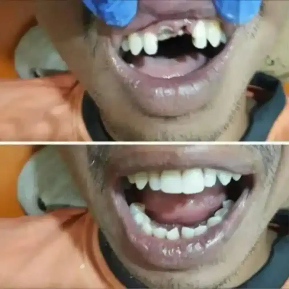 Gigi palsu, gigi kelinci, gigi gingsul,karang gigi,dll