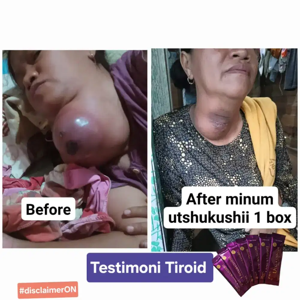 PEJUANG KANKER IKHTIAR AFC