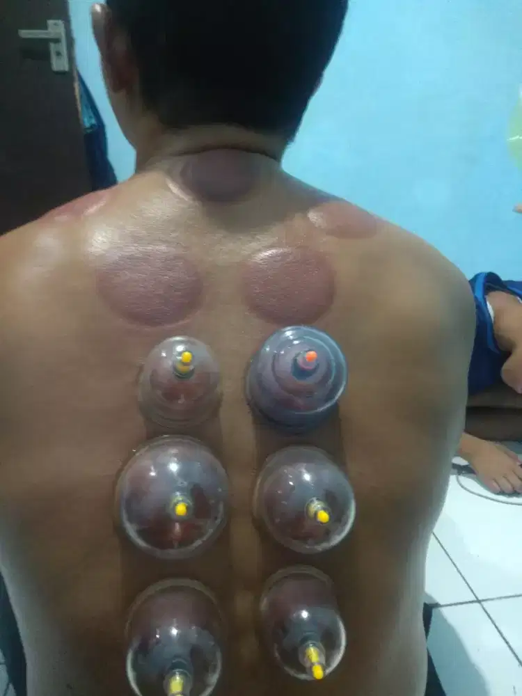 Sunah Bekam sehat dapat sunah dapat