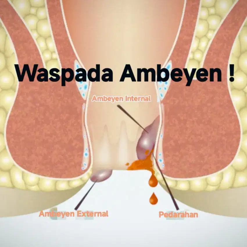 Terapi Ambeyen tanpa operasi