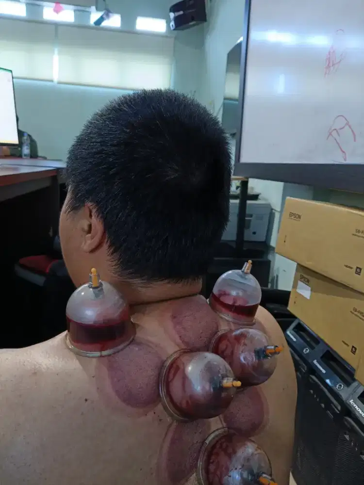 Terapis bekam repleksi