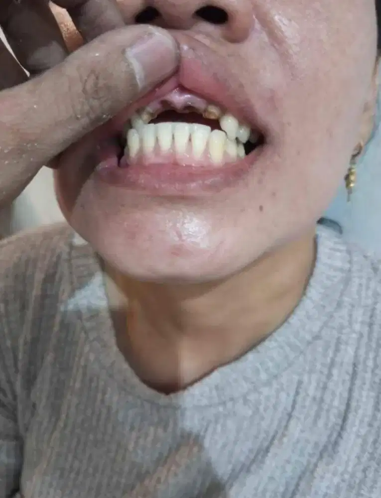 Gigi Palsu Lepasan