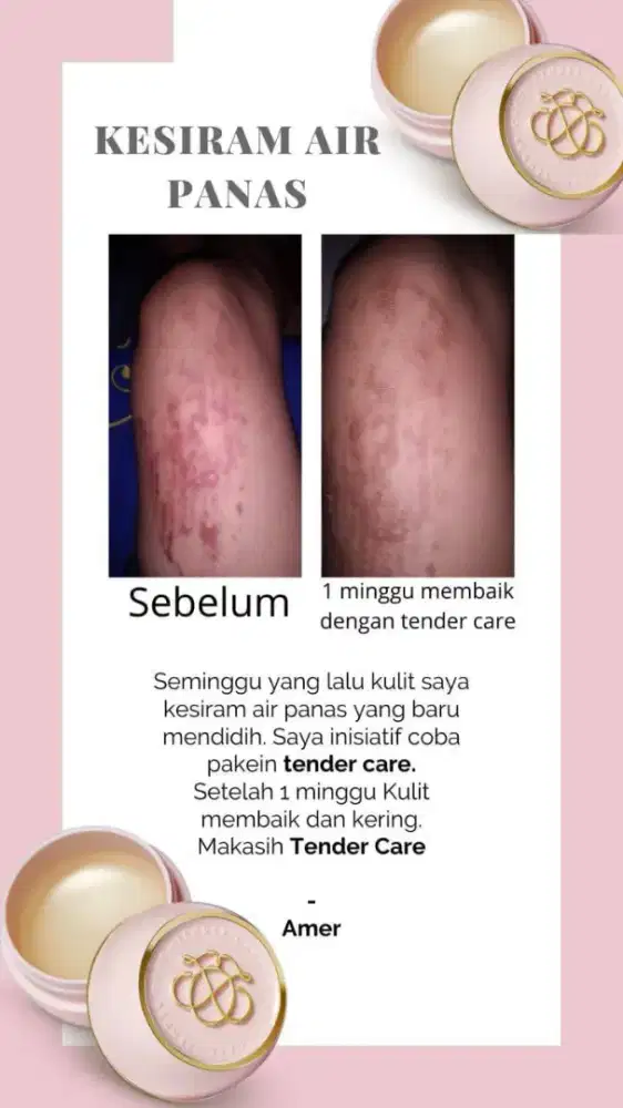 Tendercare balm