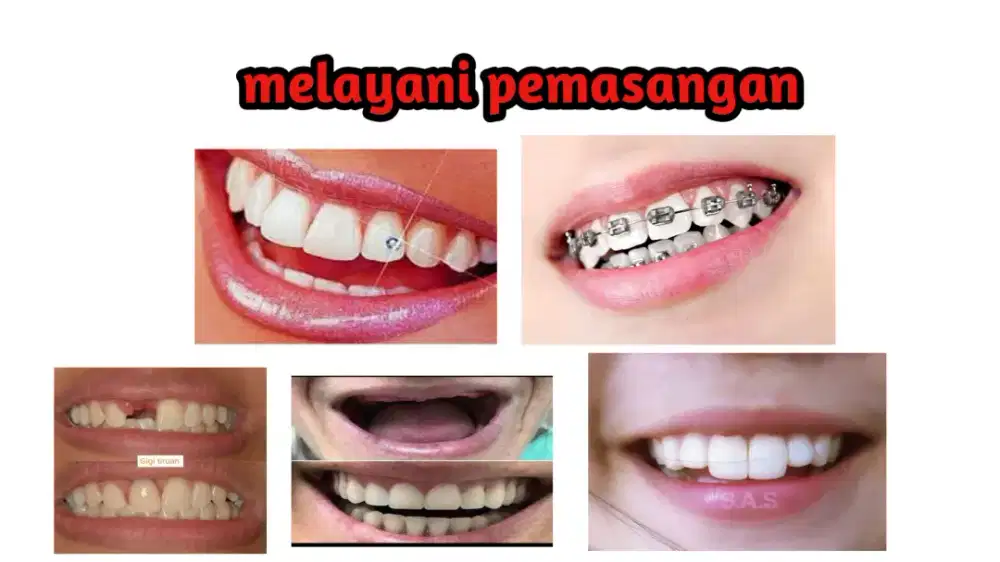 gigi palsu dan behel permata gigi
