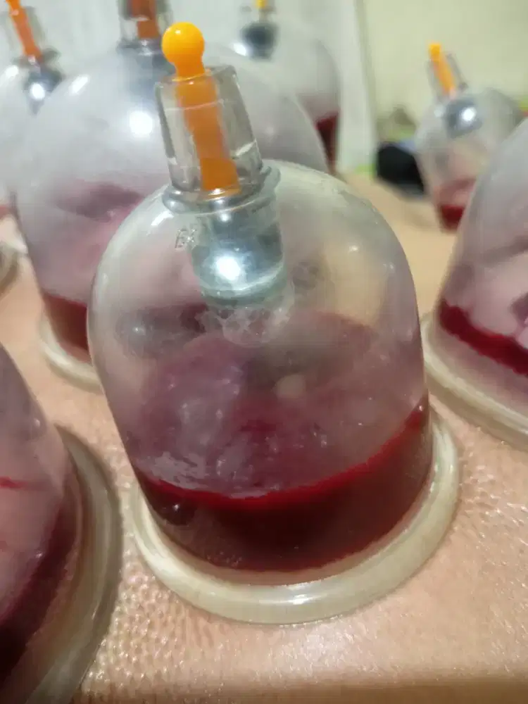 Terapi Bekam Bandung