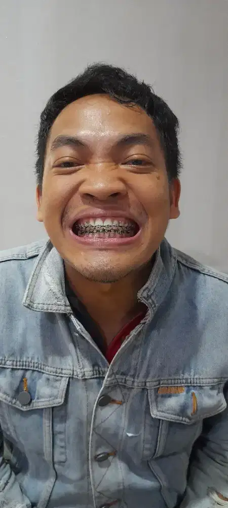 Behel kawat gigi mundur