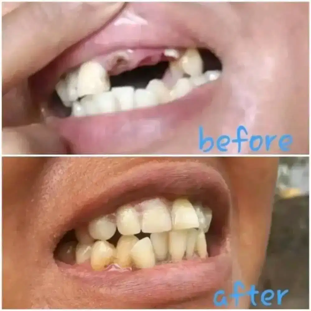 ahli gigi palsu permanen Surabaya