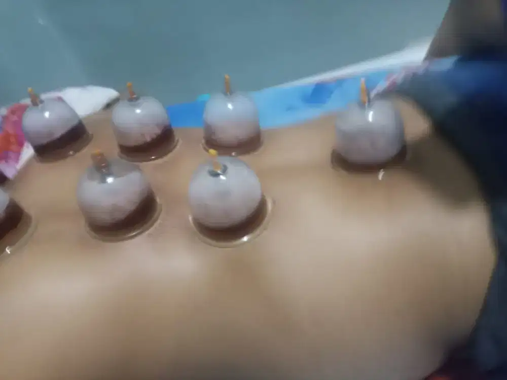 Pengobatan alternatif Bekam ,