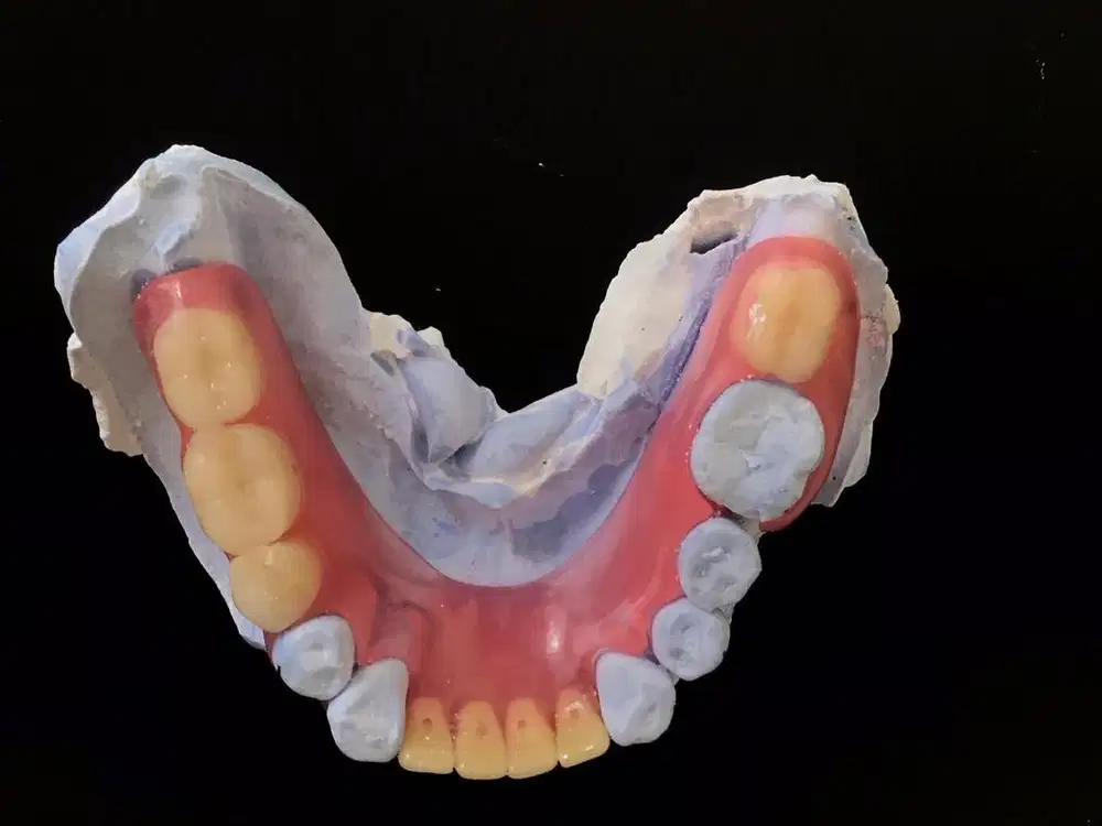Pasang gigi palsu valplast plat fleksibel anti pecah tampak natural