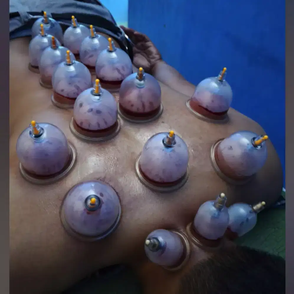 Bekam panggilan untuk berbagai penyakit