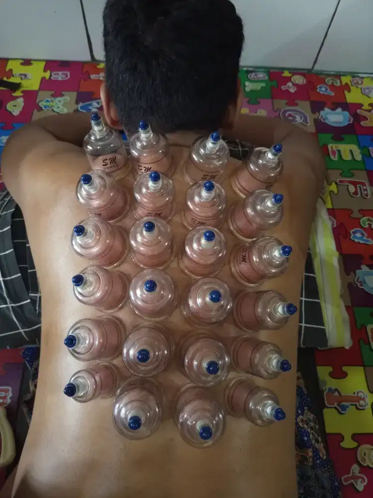 Terapi bekam kering/basah panggilan