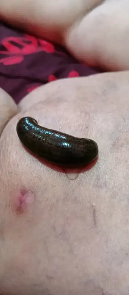 Terapi Lintah Panggilan