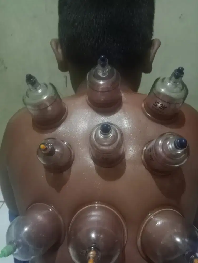 Bekam sunnah kering dan basah