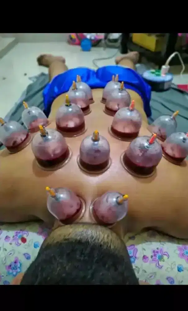 Jasa bekam basah panggilan