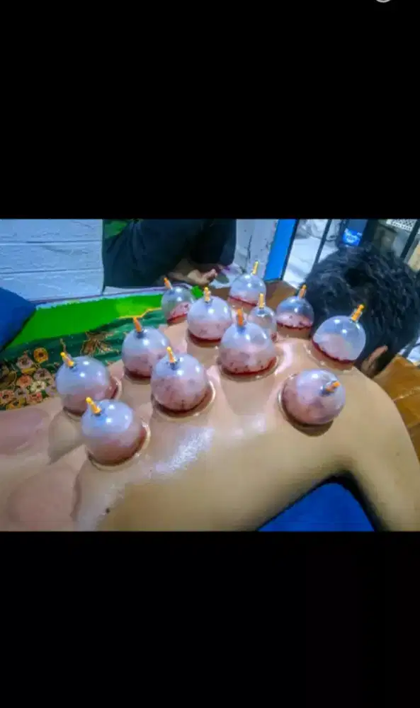 Bekam untuk berbagai keluhan seperti pegel capek