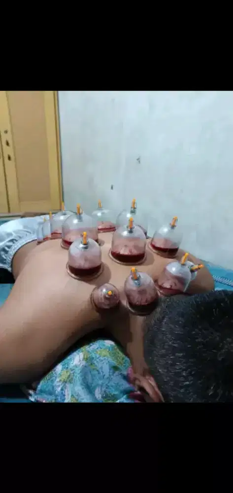 Bekam untuk pegel-pegel capek dan keluhan sakit lainnya