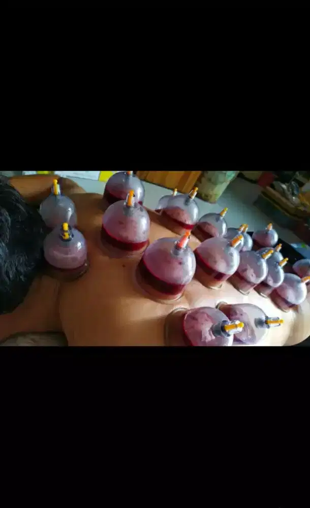 Menyediakan jasa bekam panggilan sudah memiliki sertifikat resmi