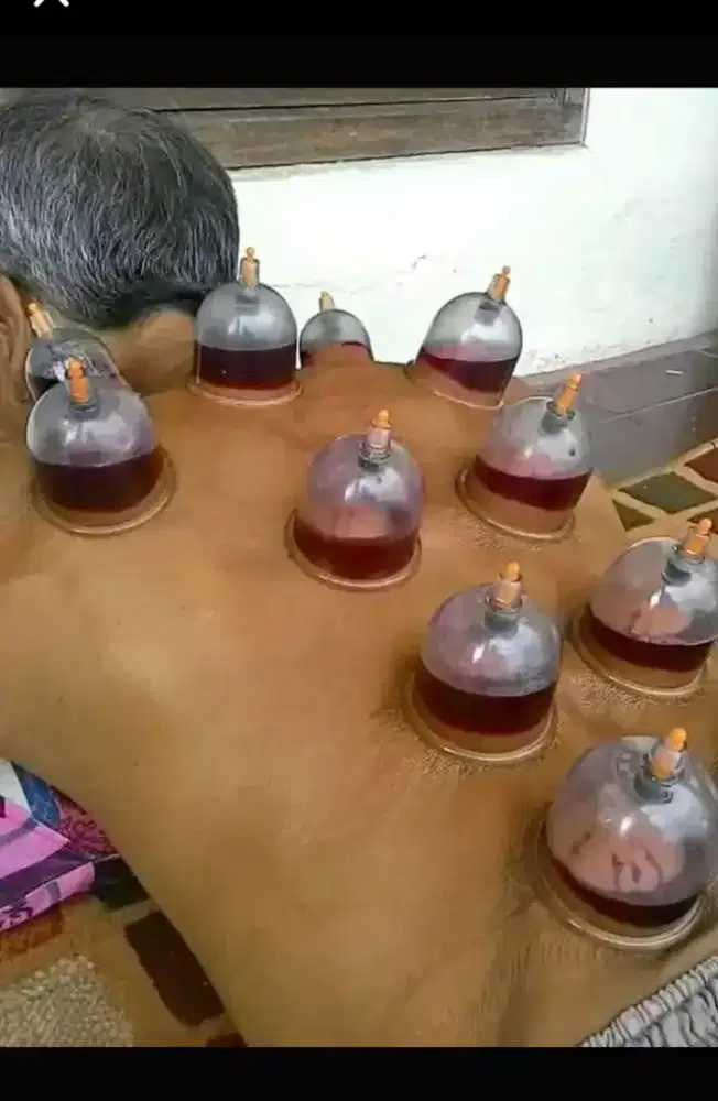 Bekam untuk mengobati dan mencegah dari berbagai keluhan sakit