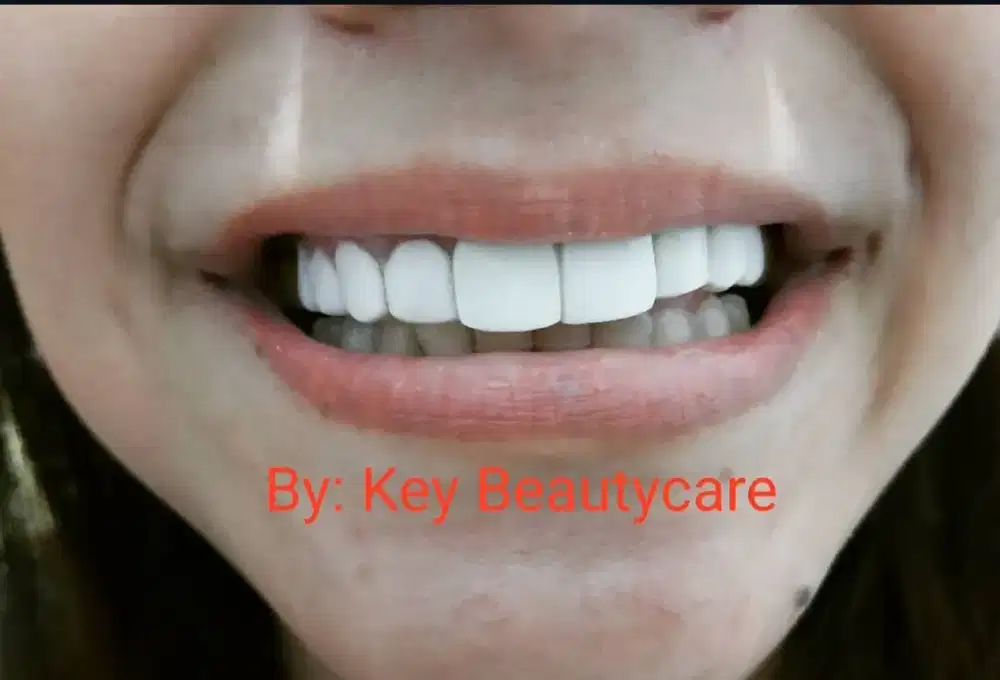 Veneer Gigi Home Care