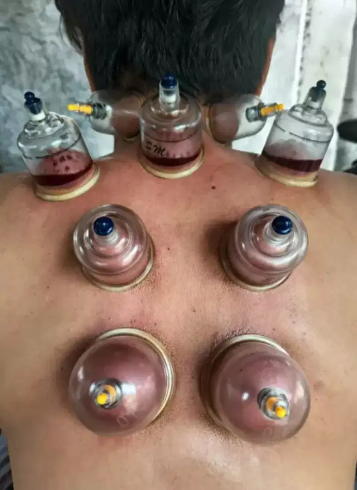 Assalamualaikum silakan yang mau bekam  .siap KRMH