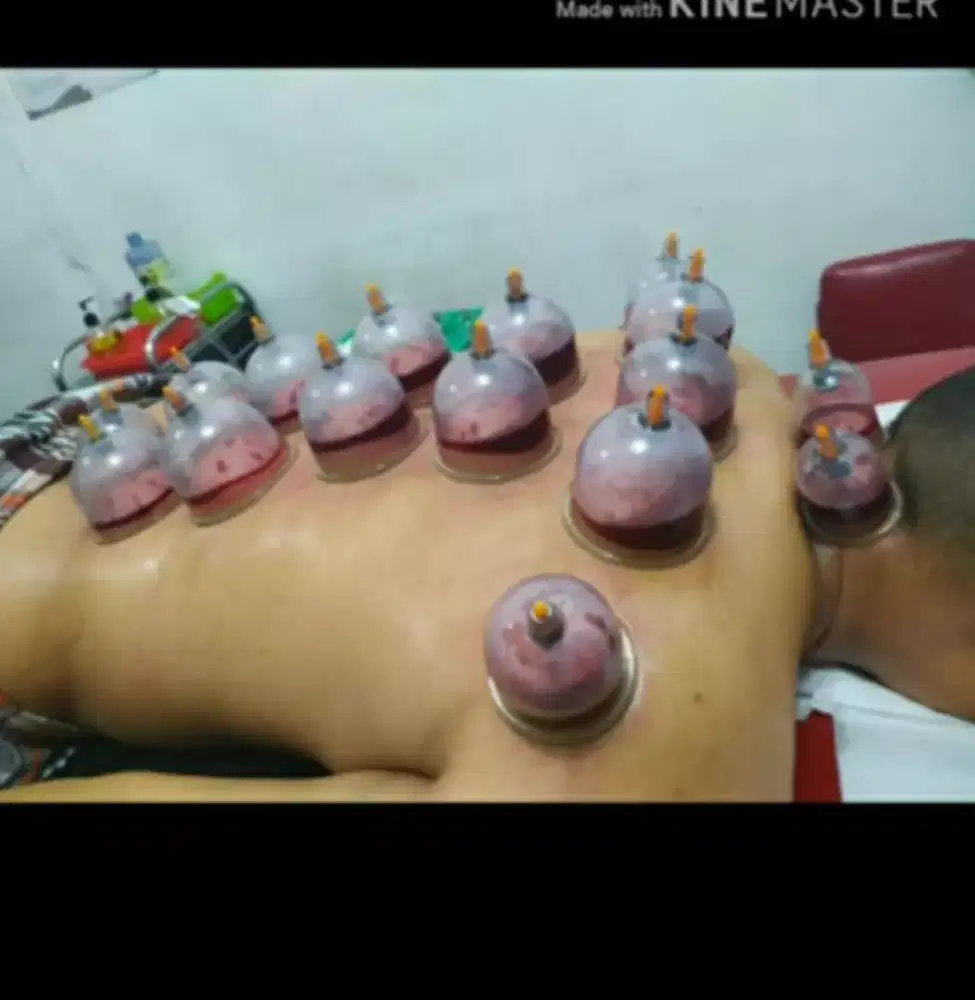 Bekam untuk pegel-pegel capek dan keluhan sakit lainnya