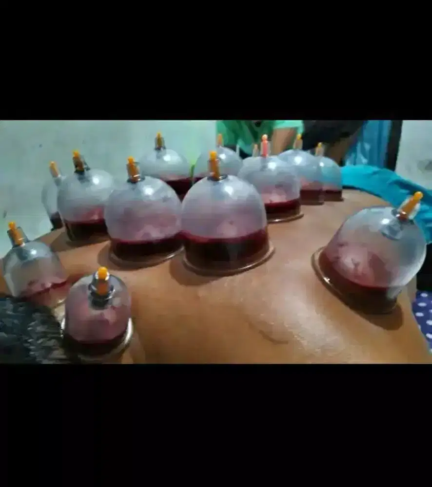 Bekam untuk berbagai keluhan seperti pegel capek