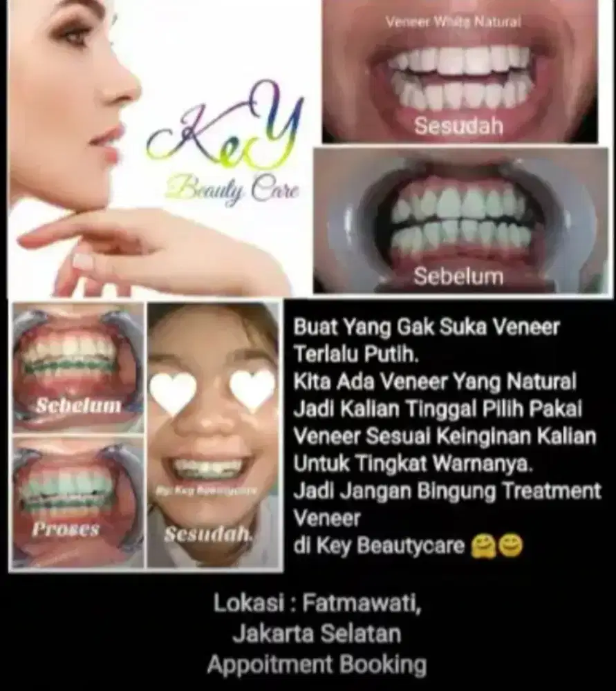 Promo Veneer gigi vinir gigi