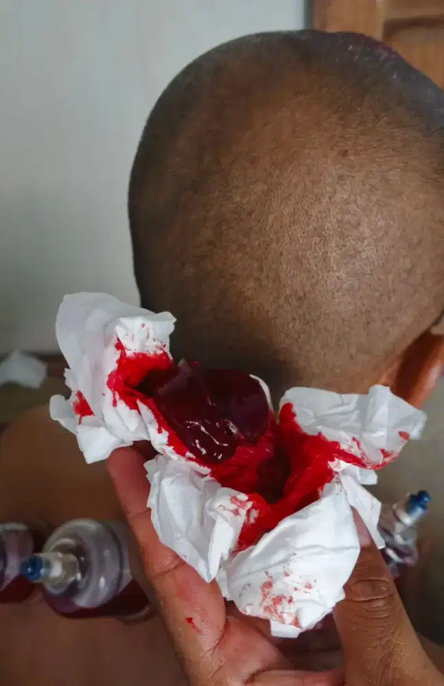 Terapi bekam merilekan badan