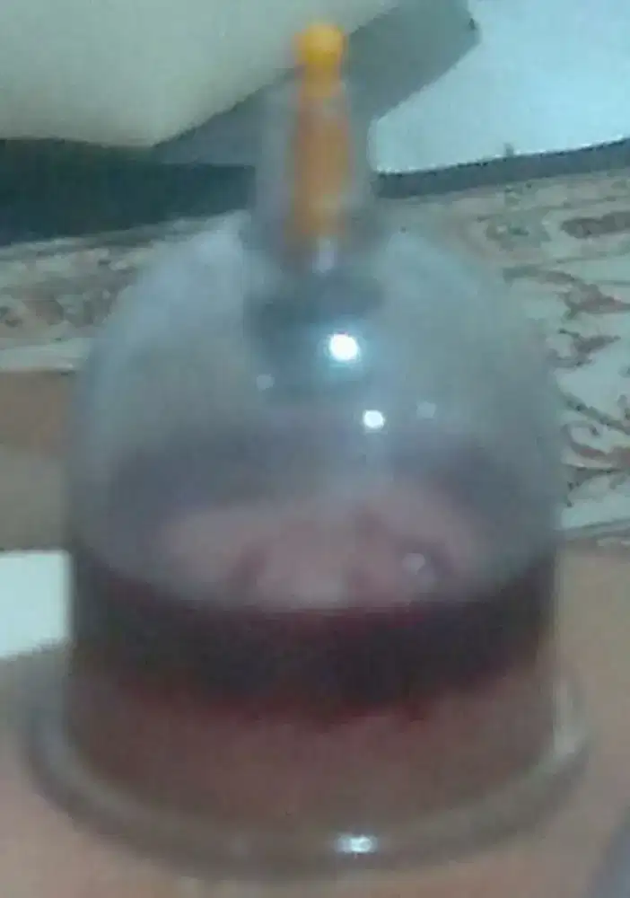 Bekam mengeluarkan darah kotor