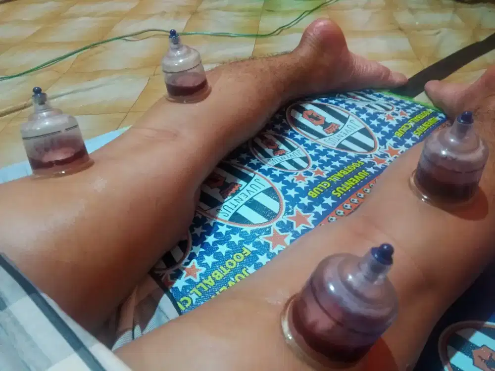 Terapi bekam penajam ( homecare )