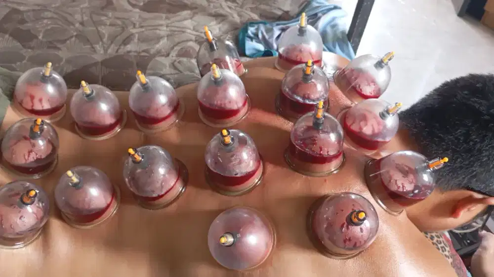 Terapi bekam panggilan