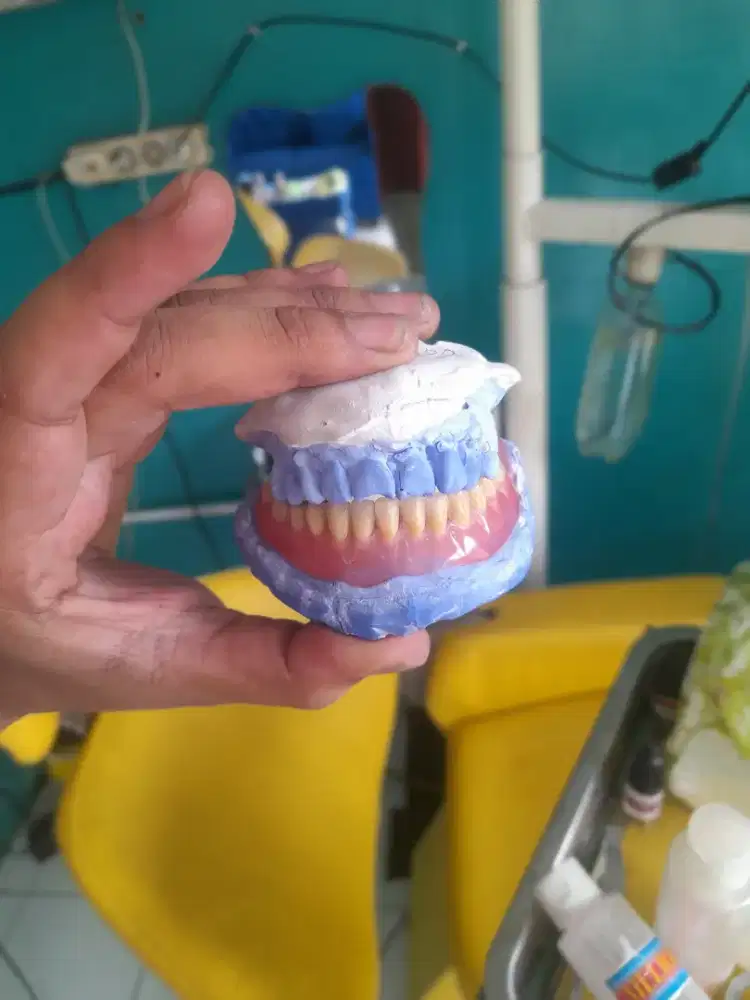 Menerima Pemasangan Gigi Palsu Lepas Pasang