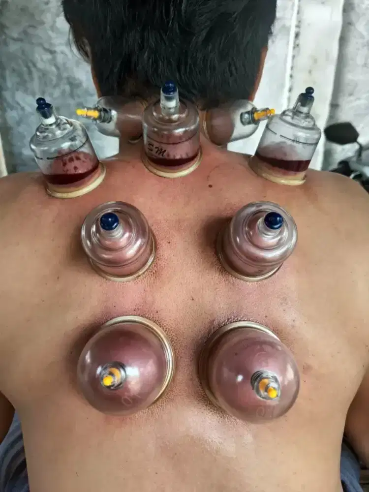 Jasa Bekam Panggilan