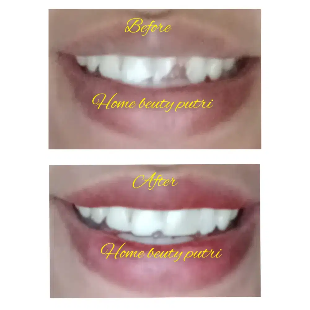 TAMBAL GIGI PERMANEN