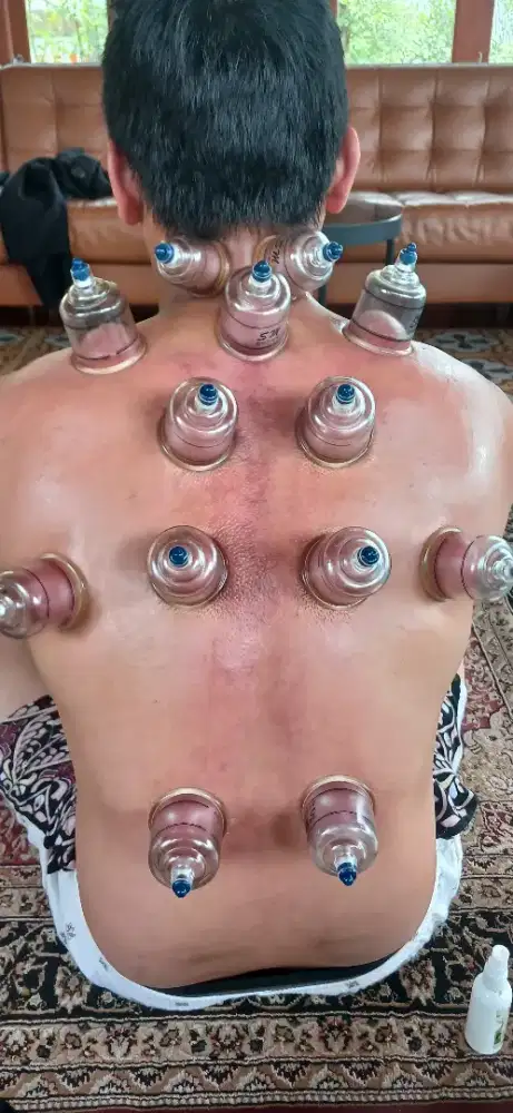 Terapi bekam kesehatan modern dan hygines