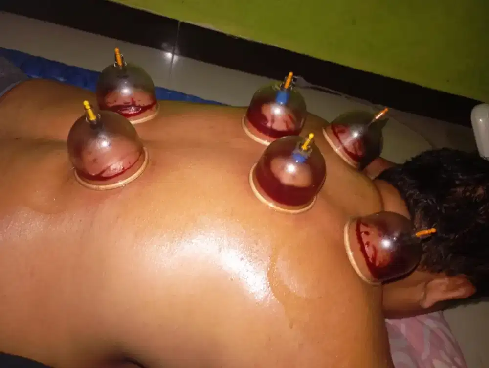 Terapi Bekam Homecare