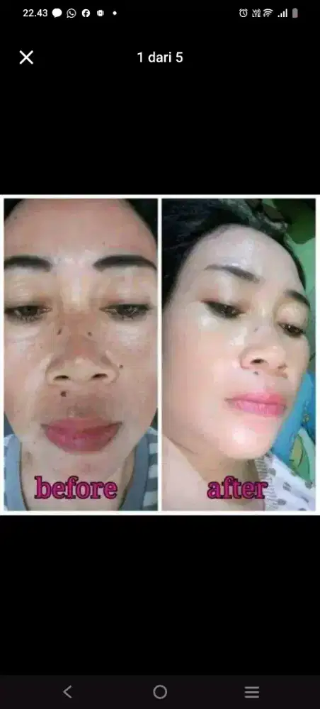 Cream serum flek hitam